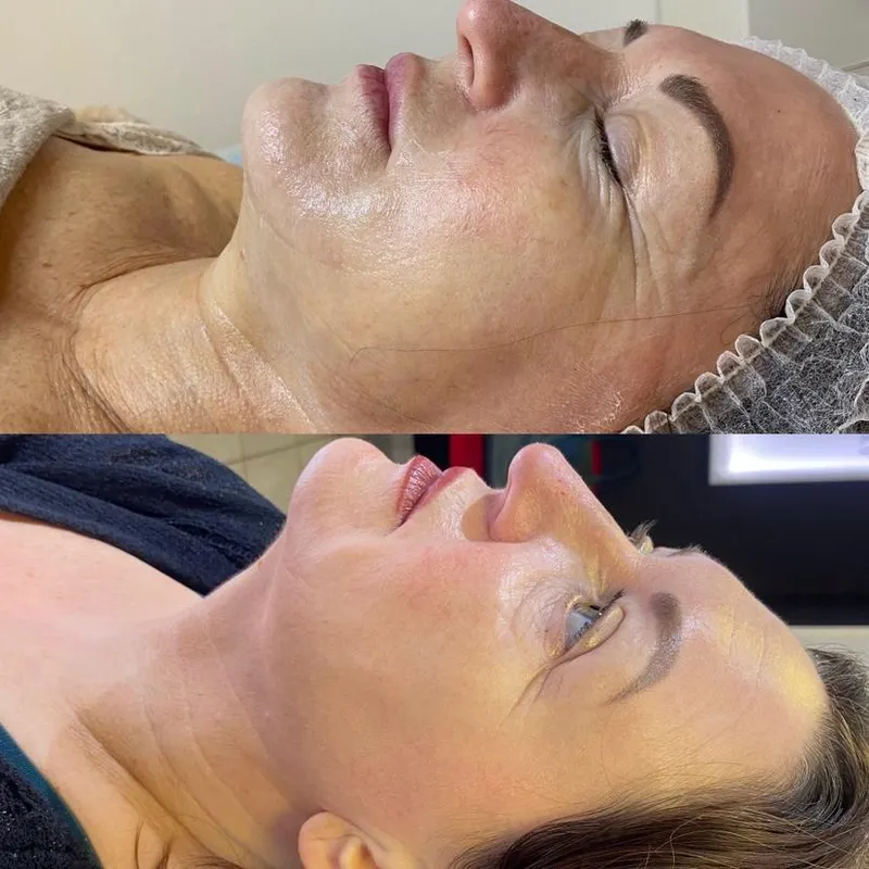 Microneedling, înainte și după, ten matur