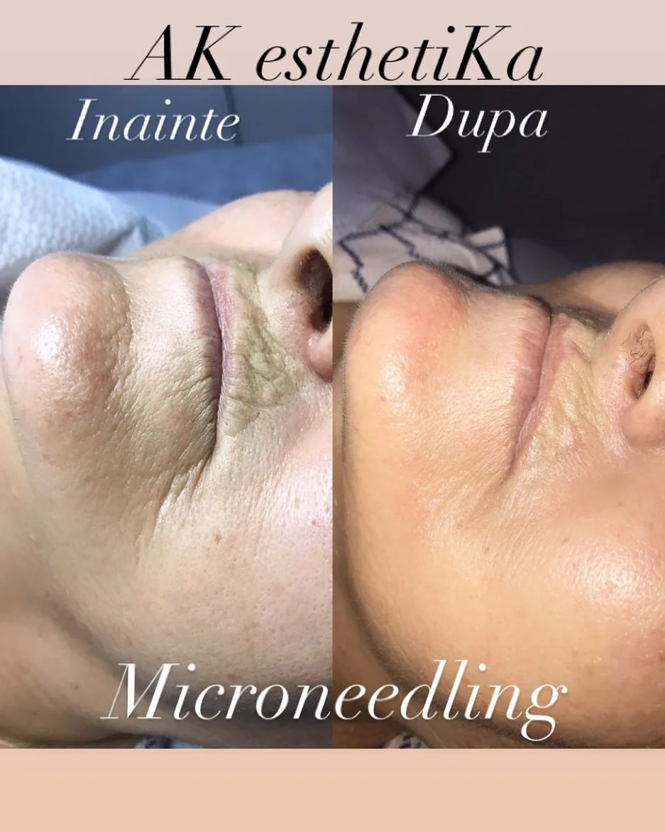Microneedling, înainte și după, textura pielii