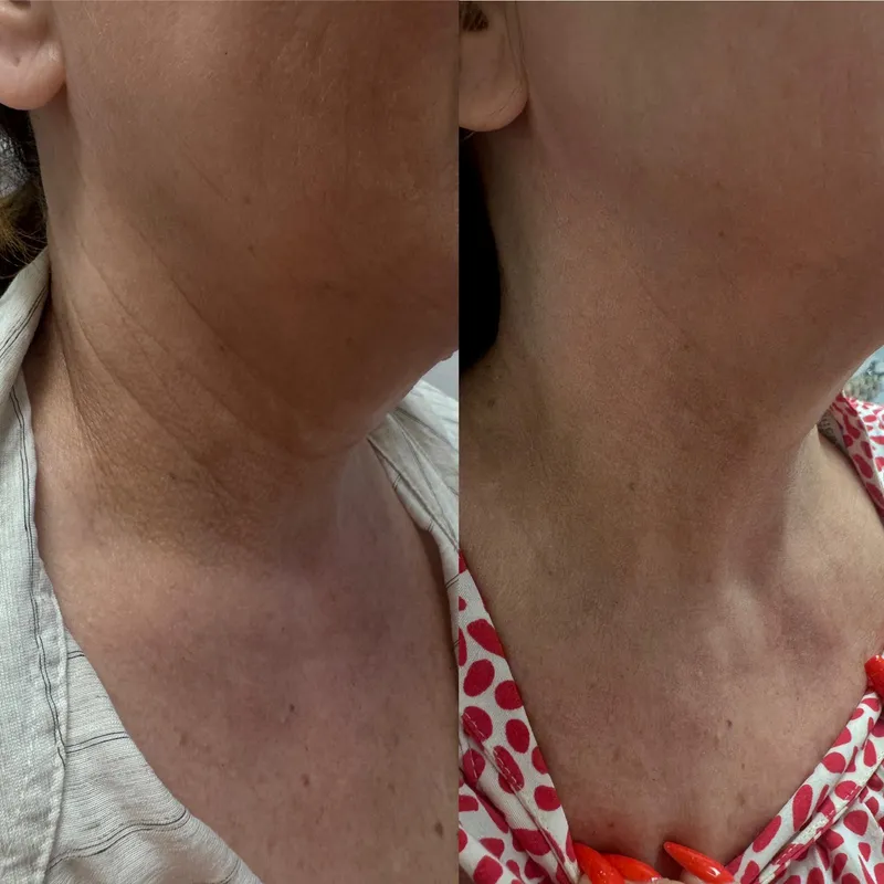 Rejuvenarea gâtului, înainte și după, profil