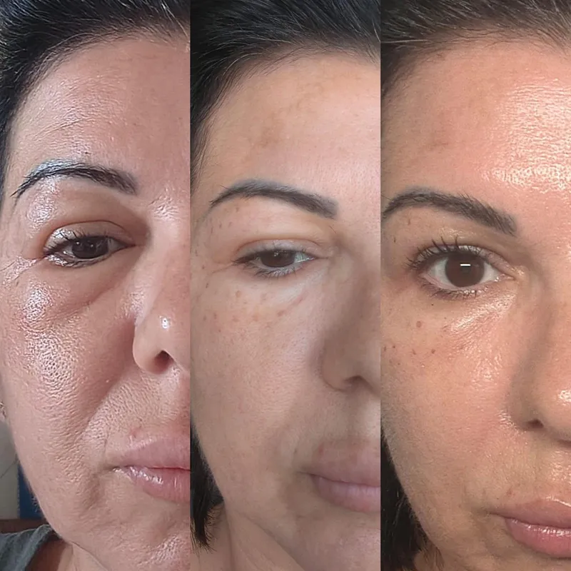 Rejuvenarea zonei ochilor, înainte și după